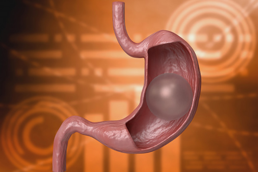 Gastric balloon placement for weight loss without surgery or anesthesia