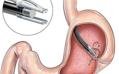 Treatment of GERD with endoscopic non-surgical Gerdx technique