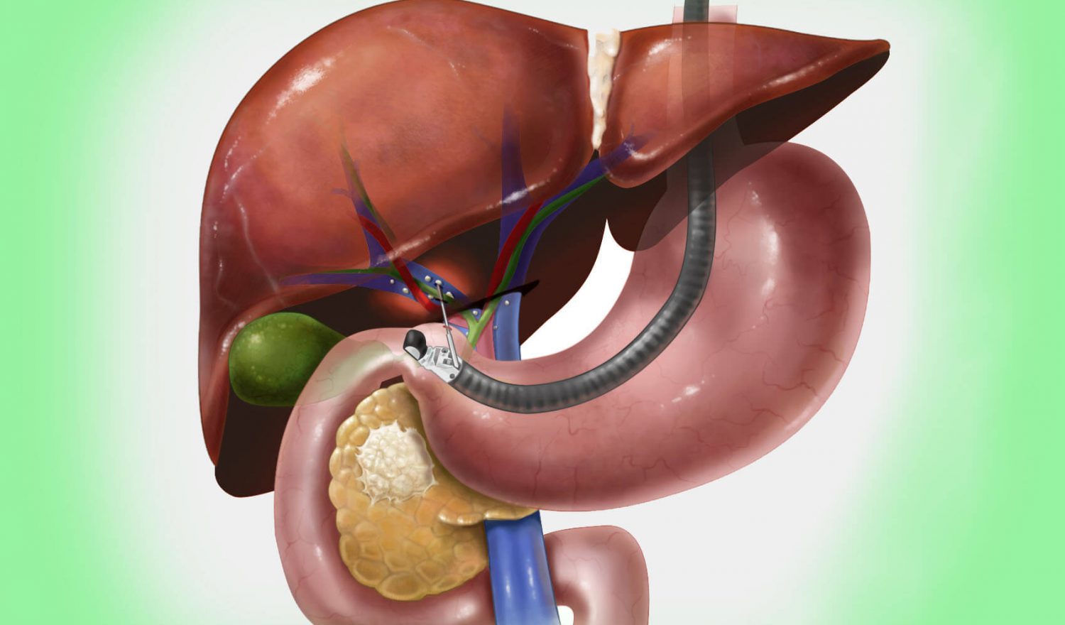 Biliary Endoscopy